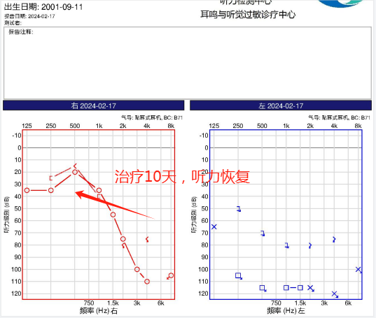 突聋女孩10天恢复听力，避免了植入人工耳蜗，这家医院治疗耳鸣耳聋的确有妙