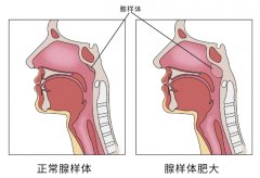 【辟谣】腺样体面容不只是腺样体肥大引起，还有这些原因！