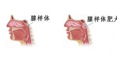 重庆诊断腺样体肥大的方法有哪些