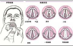 重庆治疗耳鼻喉哪家好？声带息肉的危害你了解多少?