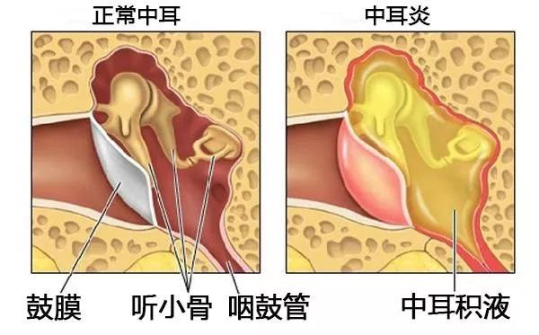 造成中耳炎的原因有哪些