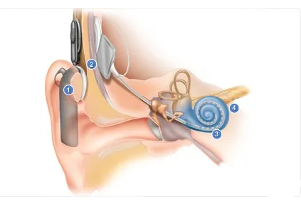 人工耳蜗