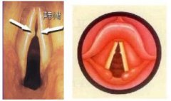 重庆声带小结的治疗方法有哪些？