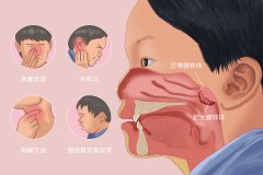 腺样体肥大是什么症状？腺样体肥大能自愈吗？