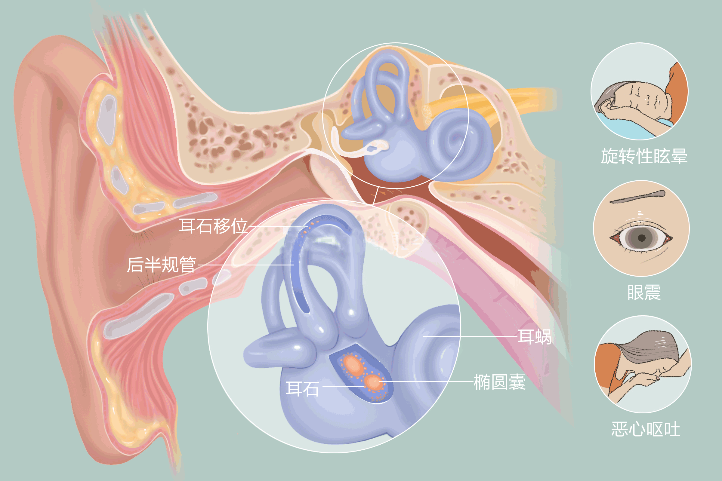 耳石症